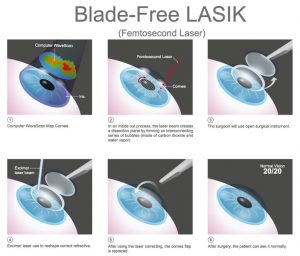 WHAT IS LASIK