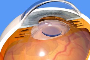 WHAT IS A INTRAOCULAR LENS