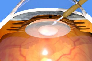 WHAT IS CATARACT